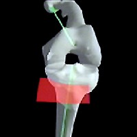 Graphical depiction of the Knee Navigation Systems (KneeNav TKR/ACL) project